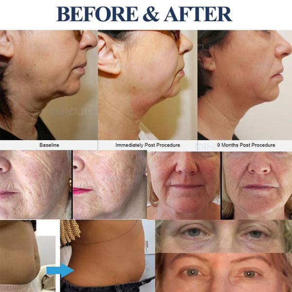 Face Lifting Hifu Beauty Machine AC110V 10000 Shots Enhance Skin Elasticity