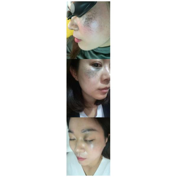 Q - Switched Pigmentation Removal Machine 1064nm / 532nm Wavelength 1 - 5HZ