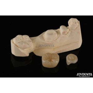 Emax Dental Inlays And Onlays Fracture Resistant 1.5mm Low Translucency