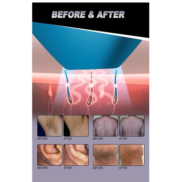 Ice Speed L 3 Wavelength Oem Commercial 808 Diode Laser Hair Removal Machine