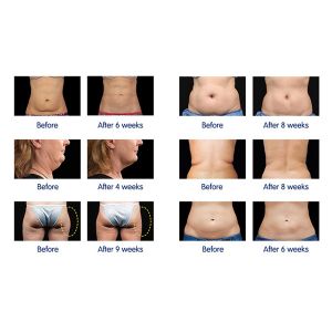 cryolipolysis cavitation and RF multifunctional cryolipolysis slimming machine