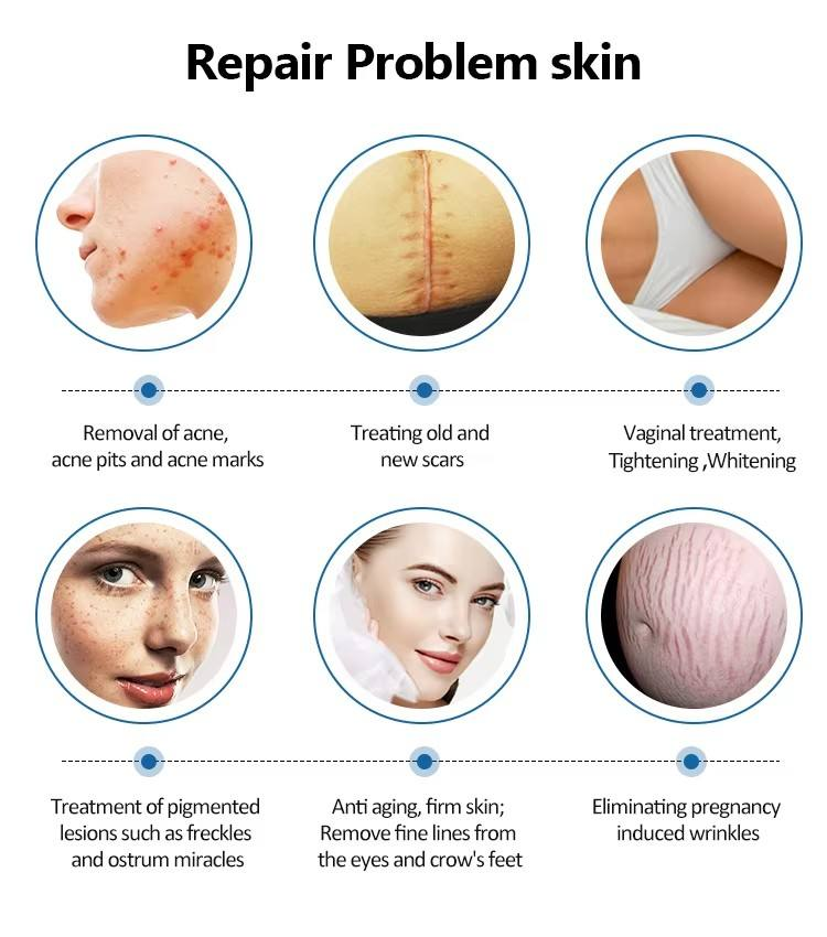 Vaginal Tightening Q Switched Nd Yag Carbon Fractional Co2 Laser Vaginal