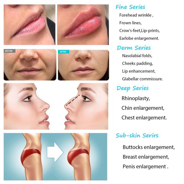 Facial Hyaluronic Acid Dermal Filler Room Temperature Sterile Syringe