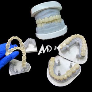 PMMA Provisional Implant Bridge Hollow Inside Ensuring Stability and Natural