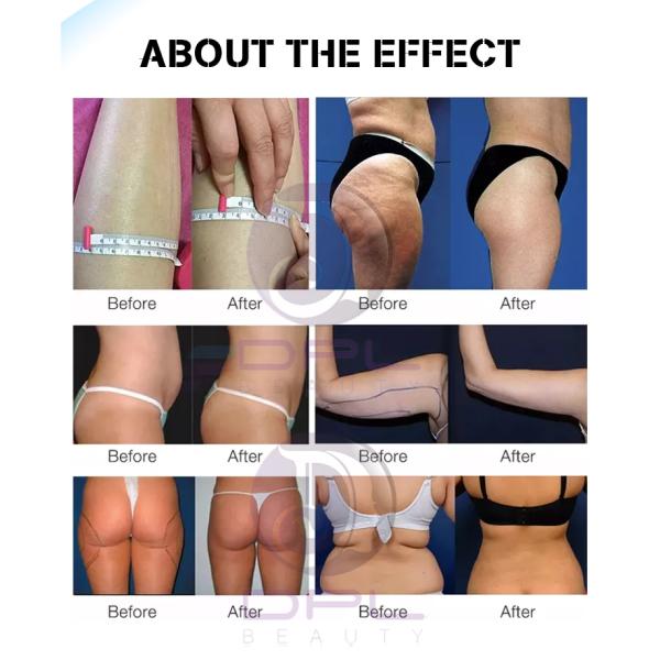 Fat Vacuum Cavitation System Liposuction 40k 80k Cavitation Slimming Machine RF Radio Frequency Skin Body Beauty Health Machine