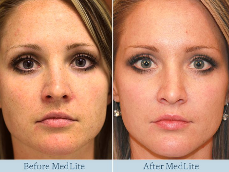 Ultra Pulse Co2 Fractional Laser  tightening rejuvenation skin peeling beauty machine MB06