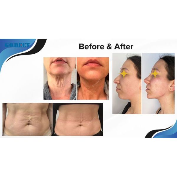 Lipolysis Non Surgery Fiber Laser Facial Lifting Laser Endolaser Endolift 635nm 980 Nm 1470nm Equipment With Joule