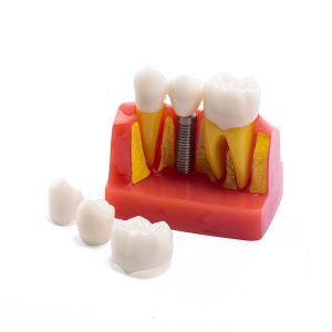 Class III Instrument Classification Dental Study Model for Dental Practice and