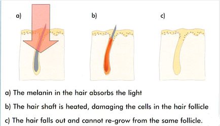 SHR IPL system intense pulsed light 10hz fast shr hair removal machine