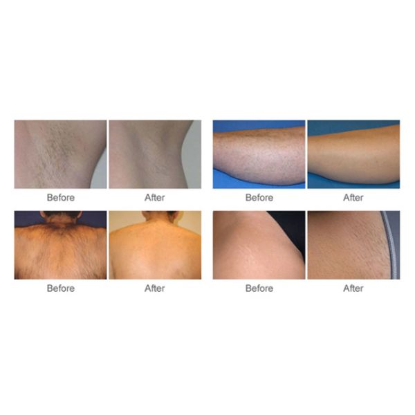 808nm Professional Diode Laser Hair Removal Machine Used For Salon SPA