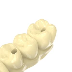 Dental Bridge Resin Biocompatible 3d Printing Resin