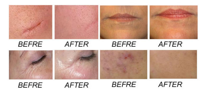 RF Tube Co2 Vigina Tightening Machine 40W Incentive Laser Labia Whitening