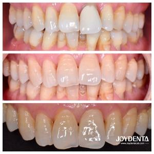 Zirconia dentures that imitate natural teeth