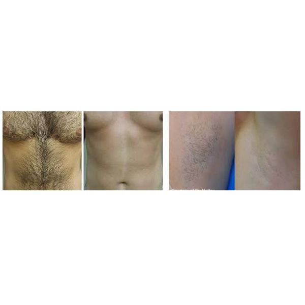 CE Laser Beauty Machine , 12 * 24mm Spot Size Laser Hair Removal Machine For All Skin