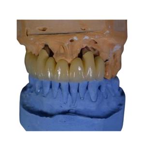 FDA PFM Crown Porcelain fused to Metal Crown