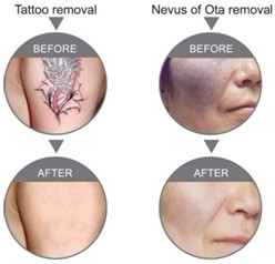 Medical KTP/ YAG Laser Tattoo Removal Machine For Pigmentation Removal 220V