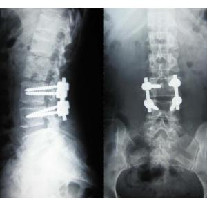 Konida Digital Image X Ray Dry Film Waterproof For Fuji 3000