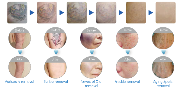 High end QSwitched ND YAG laser tattoo removal machine q switched nd yag laser picosure fractional OEM/ODM with 1000w power, color OEM