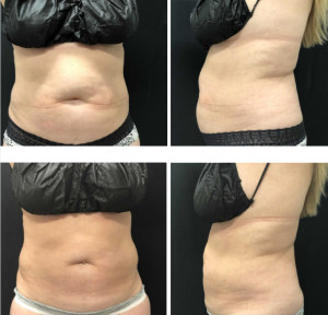 4 In 1 Lipolaser 600w 90kPa Cool Slimming Machine