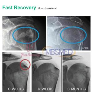 Focused Shockwave Technology The Key to Successful Calcifications Rehabilitation