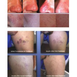 Beauty salon Equipment electrolysis machines for spider vein removal machine