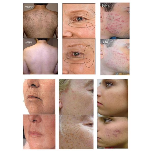 E-light Acne Keyword Beauty Equipment Laser Ipl Shr Hair Removal Machine