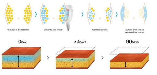 Weight Loss Fat Freezing Cryolipolysis Slimming Machine