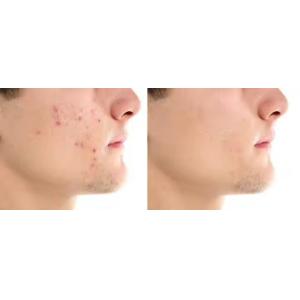 Lifting Ultrasound Introduction Lifting and Tightening Beauty Instrument