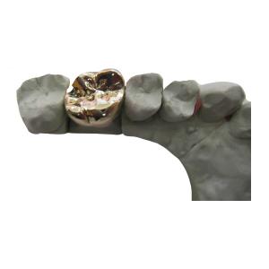 China Full Metal PFM Dental Crown Bridge High Tech Biological Material on sale