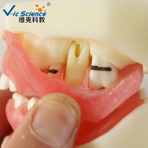 Professional Medical Dental Study Models VIC-L5 Peridontal Disease Model