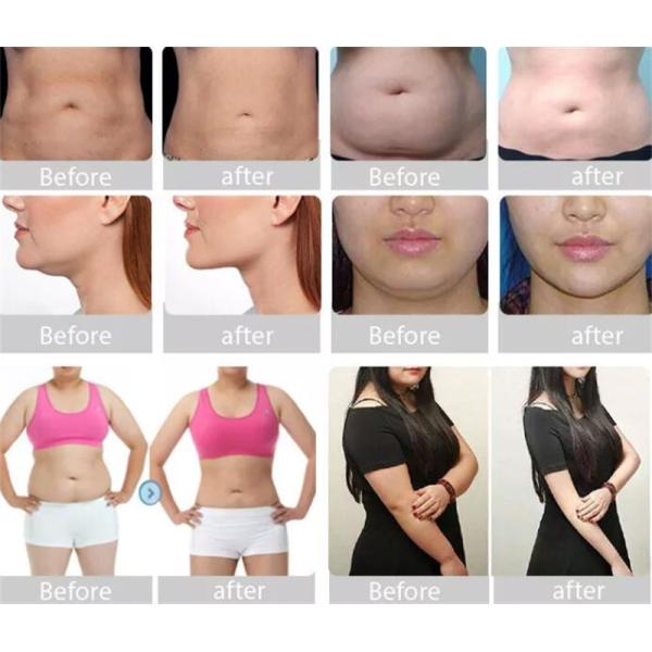 Portable 650nm Cryolipolysis Body Slimming Machine Fat Freezing 6 In1