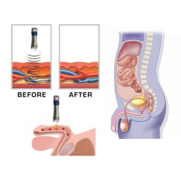 5-200 Mj Muscle Relaxer Machine , Shockwave Therapy Device For Pain Relief