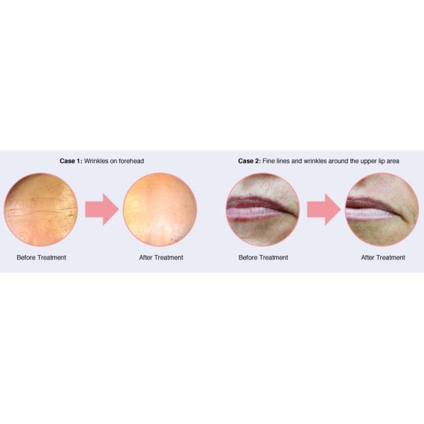 water and oxygen Skin Care oxygen jet peel beauty equipment