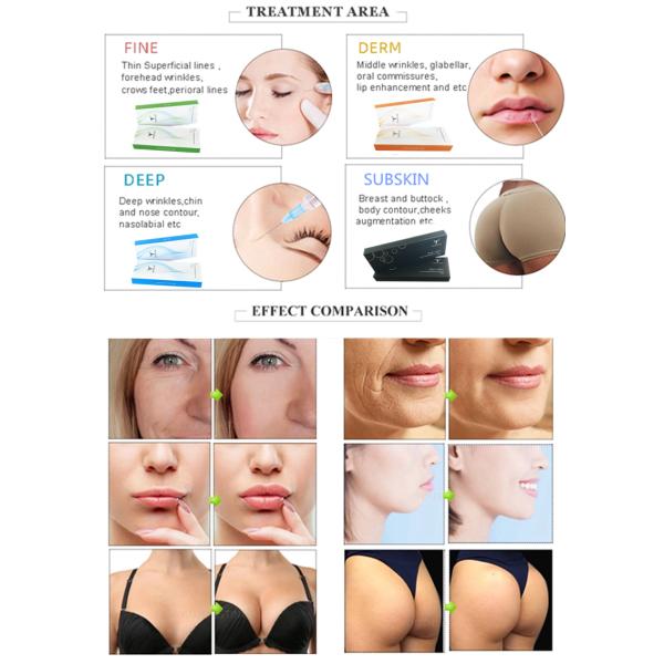 Transparent Hyaluronic Acid Injections For 9 - 12 Months Facial Longevity