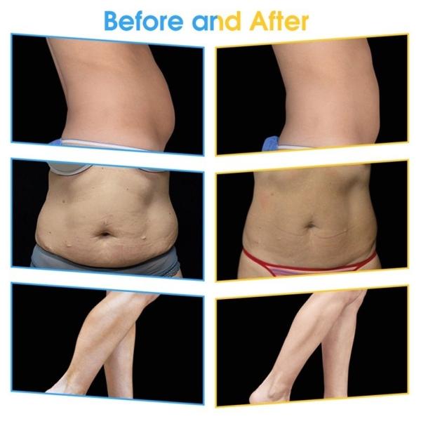 EMS Weight Loss Machine EMSCULPT Hi-Emt Emslim Body Slimming Muscle Stimulation