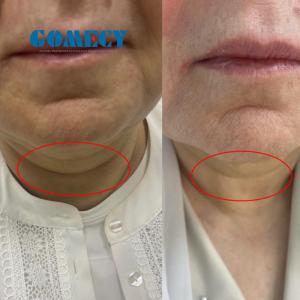 Body Lipolysis Laser Machine 1470nm Air Cooling With Cannula