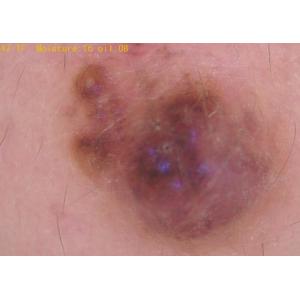 Handheld Digital Dermatoscope Video Dermatoscope Wifi Connection to Mobilephone