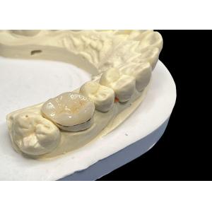 Hypoallergenic Porcelain Inlays Onlays for Teeth Repair Natural Color and Easy