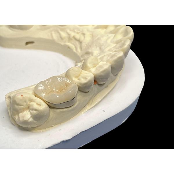 Hypoallergenic Porcelain Inlays Onlays for Teeth Repair Natural Color and Easy
