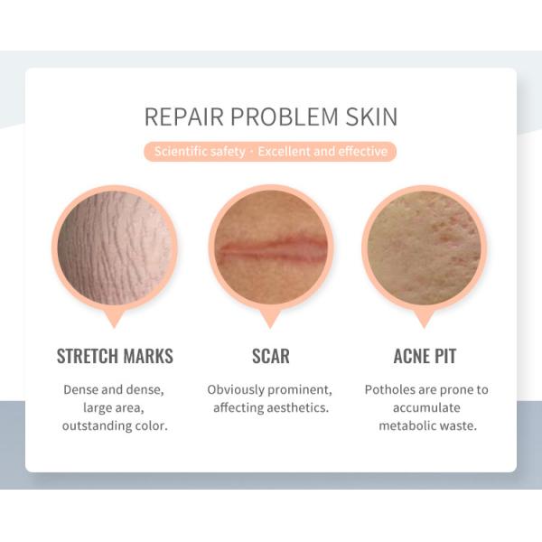 Wrinkle Removal Carbon Dioxide CO2 Fractional Laser Machine 0.1mm-2mm