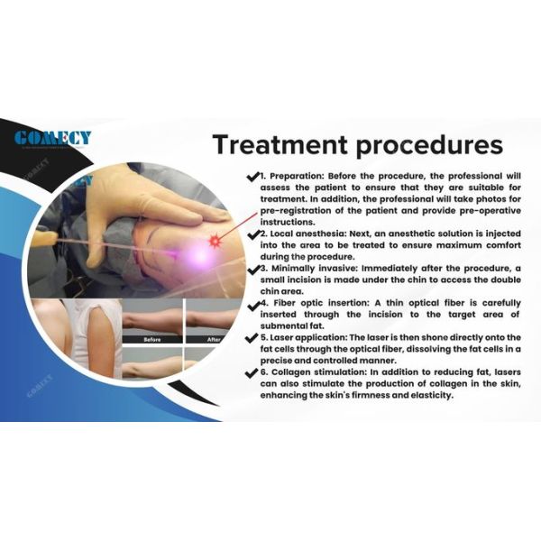 Lipolysis Non Surgery Fiber Laser Facial Lifting Laser Endolaser Endolift 635nm 980 Nm 1470nm Equipment With Joule