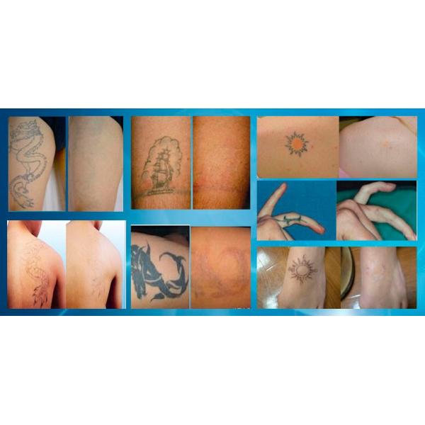 650nm Laser Therapy Equipment For Picosecond Tattoo Removal / Eyebrows Remover