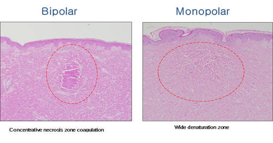 Wellness center Fractional RF Microneedle Acne Scar Removal Beauty Machine