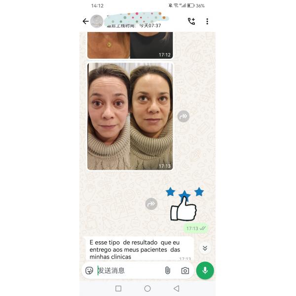 DYSPORT 500 Units For Face Lines Botulinum Toxin Type A