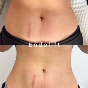 Fat Reduction Endolift Laser Machine 15W 20W 1470nm Cellulite Reducer Machine