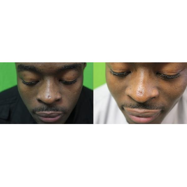 Salon CO2 Fractional Laser Machine Stretch Mark Removal With RF Metal Tube