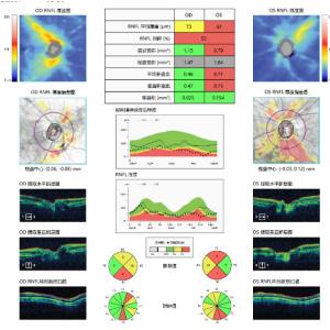 OCT Optical Coherence Tomography Machine Posterior Segment