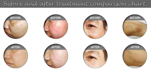 2014 Christmas Promotion ipl hair removal beauty equipment/e-light ipl rf+nd yag laser multifunction machine