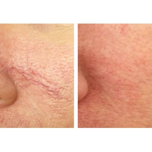 CE Passed Portable Laser Spider Vein Removal Machine 980nm Varicose Veins Removal