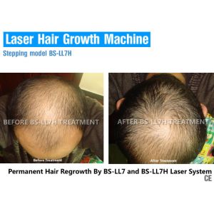 Low Level Laser Therapy For Hair Growth